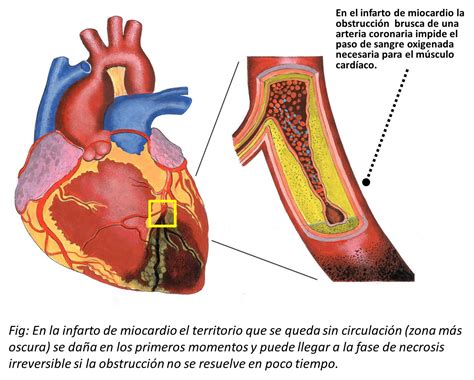 infarto al miocardio